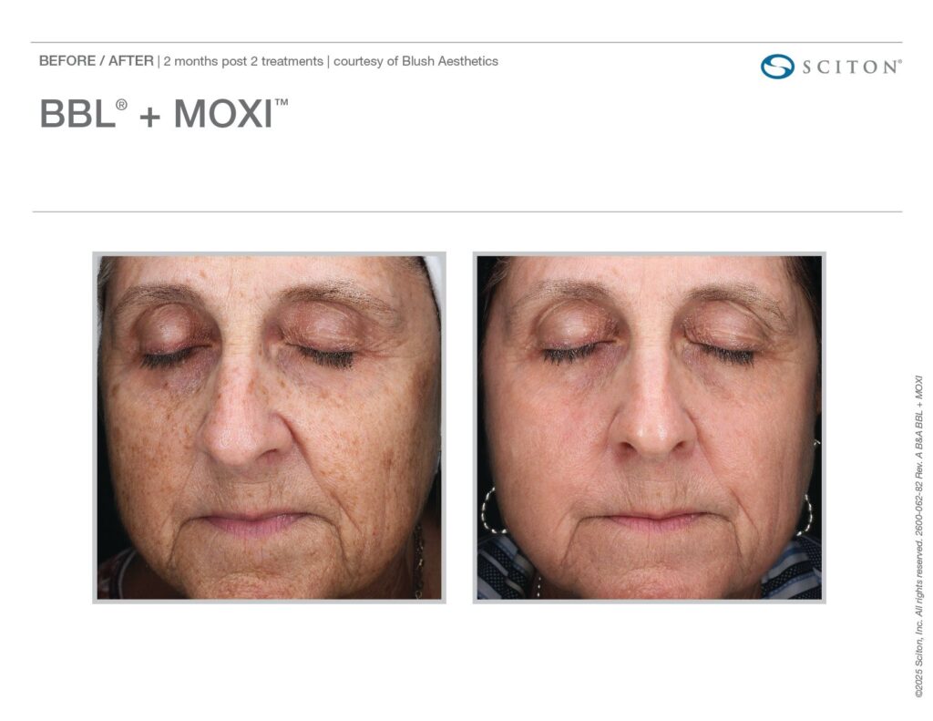 Skin Laser Treatment in San Diego