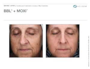 Skin Laser Treatment in San Diego