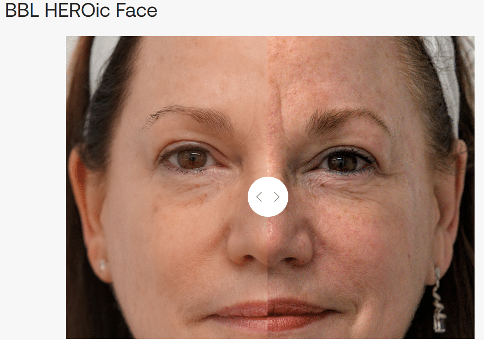 BBL Laser treatment in San Diego